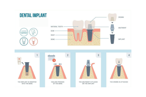  dental implants sTEPS