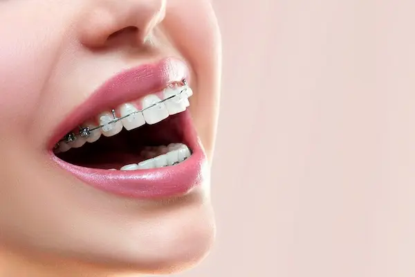 What Are Partial Braces and Are They Right for You?